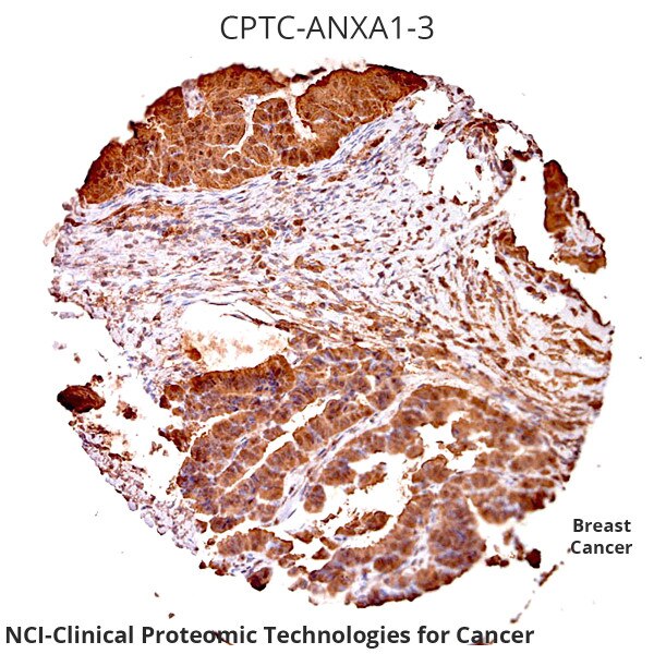 IHC of Breast Cancer labeled with DSHB antibody CPTC-ANXA1-3 against Annexin A1. Image Credit: NCI-Clinical Proteomic Technologies for Cancer. 